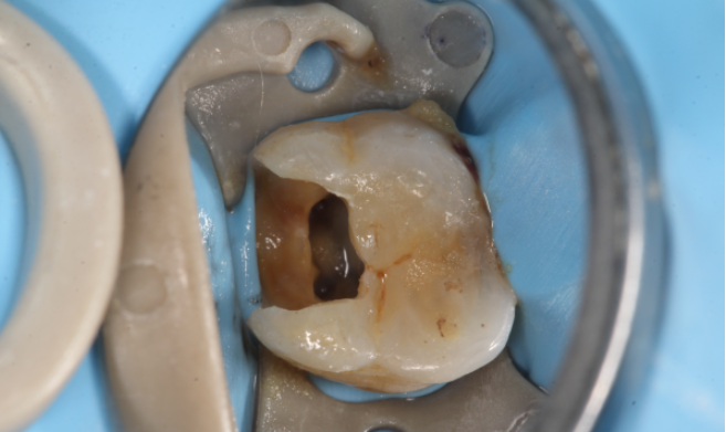 有谁做过牙齿 根管治疗,疼不疼?