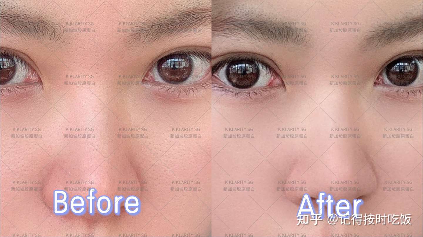 Klarity Sg Collagen胶原蛋白真的能抗衰老吗 长期吃有副作用吗 知乎