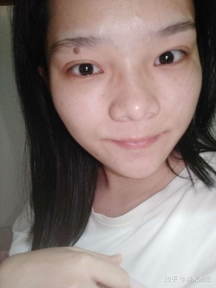 别的不知道,但是我左眼上面有一颗特大的痣,我正在考虑要不要把它去掉
