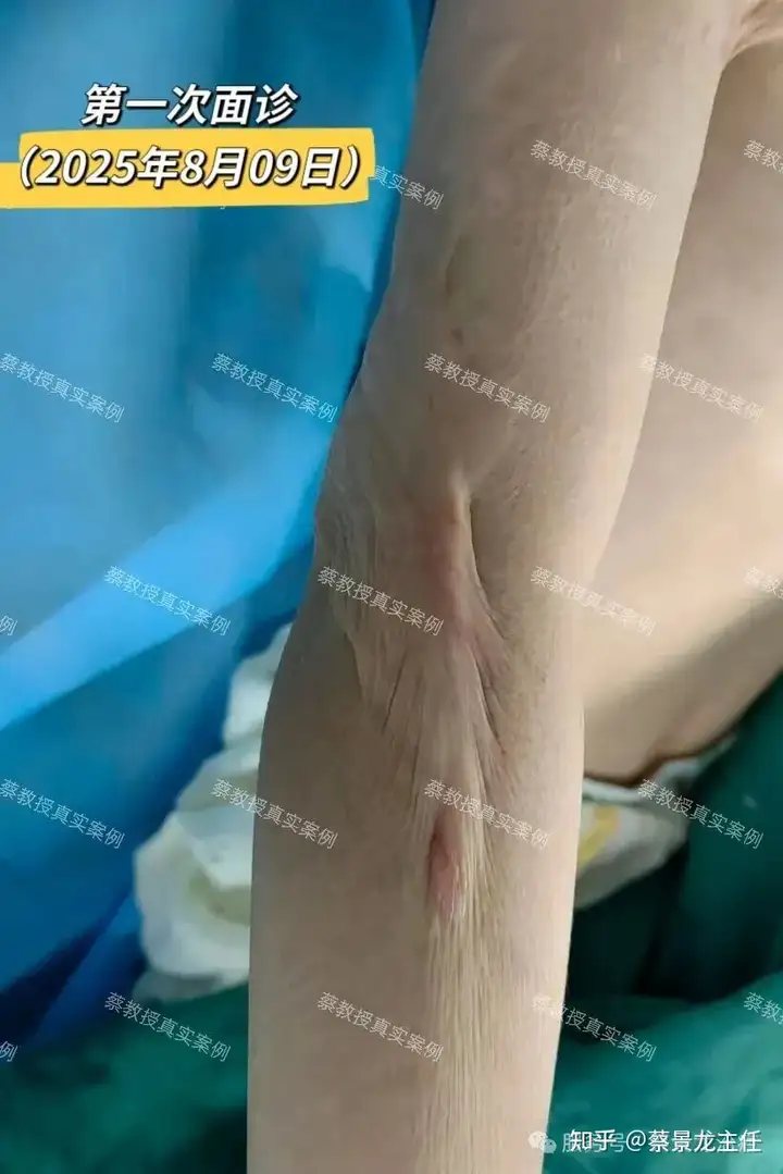 手术+激光+浅放治疗：儿童烧伤瘢痕的规范化修复之路 