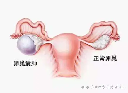 重庆哪里可以供卵做试管婴儿（早衰！不孕！更年期提前！ 卵巢囊肿手术对卵巢功能影响多多）