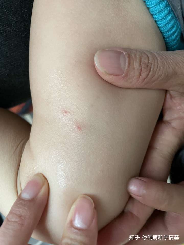 什么虫咬人是两个针眼大小的点