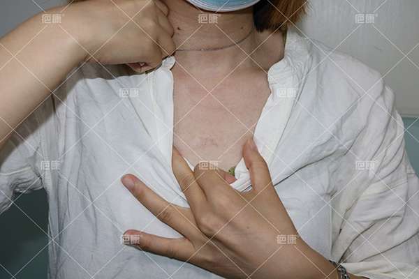河南邝女士前胸疤痕疙瘩治疗案例 