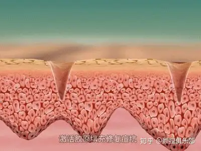 痘坑