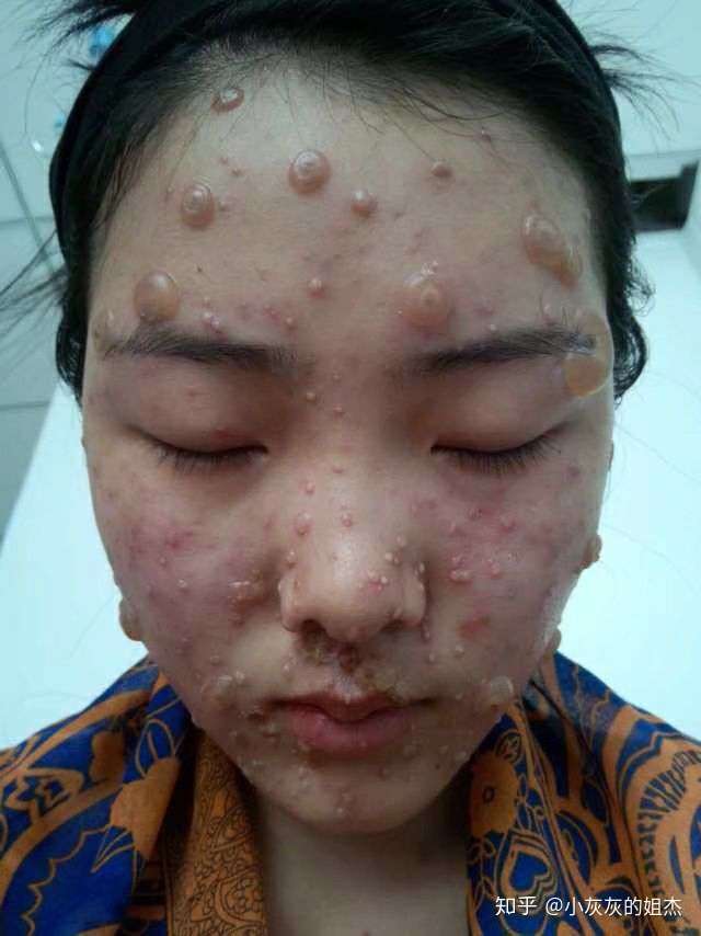 成人长水痘是什么样的经历?