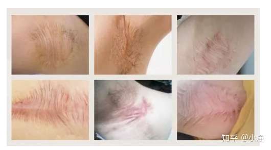 不要信啊,不管是手术还是药物治疗,迄今为止仍没有办法可以根治狐臭