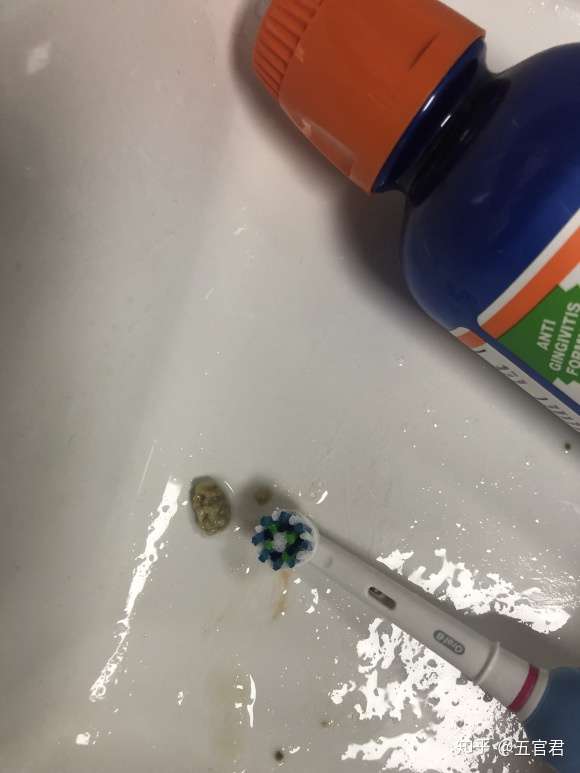 你见过最大的扁桃体结石有多大