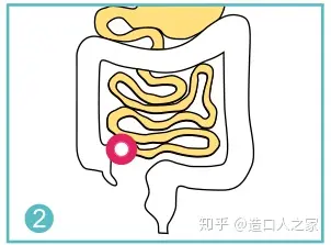 肠造口分类图片