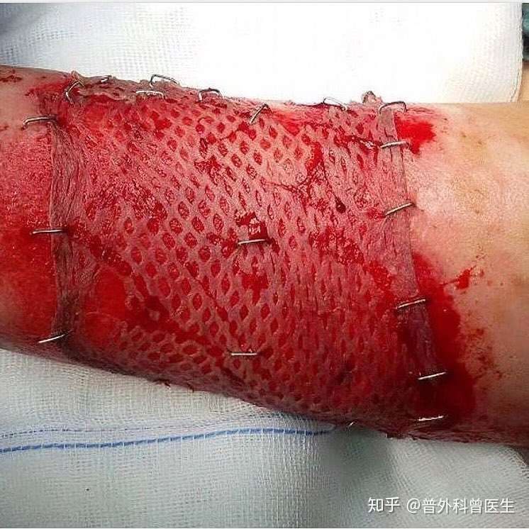 植皮术
