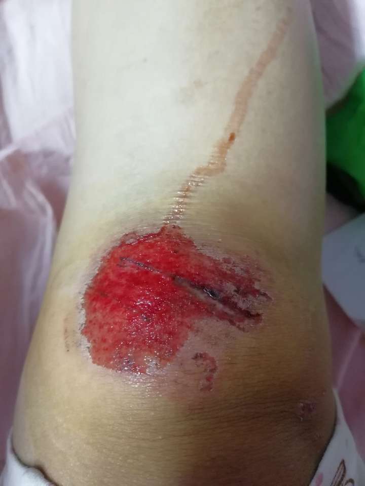 皮肤破后流血结痂愈合是一个怎样的过程