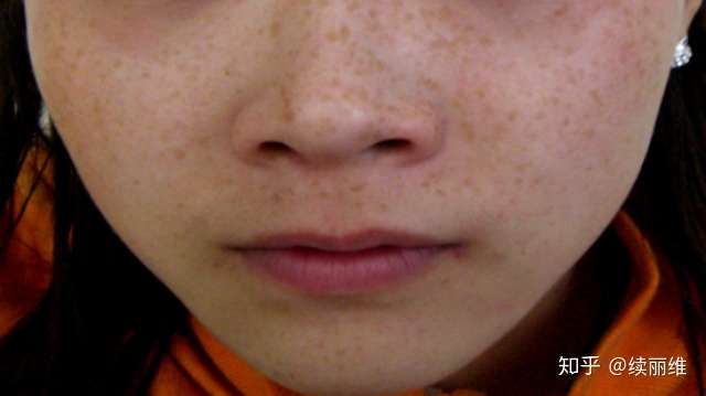 色斑怎么祛 先得了解你长的是什么斑 知乎