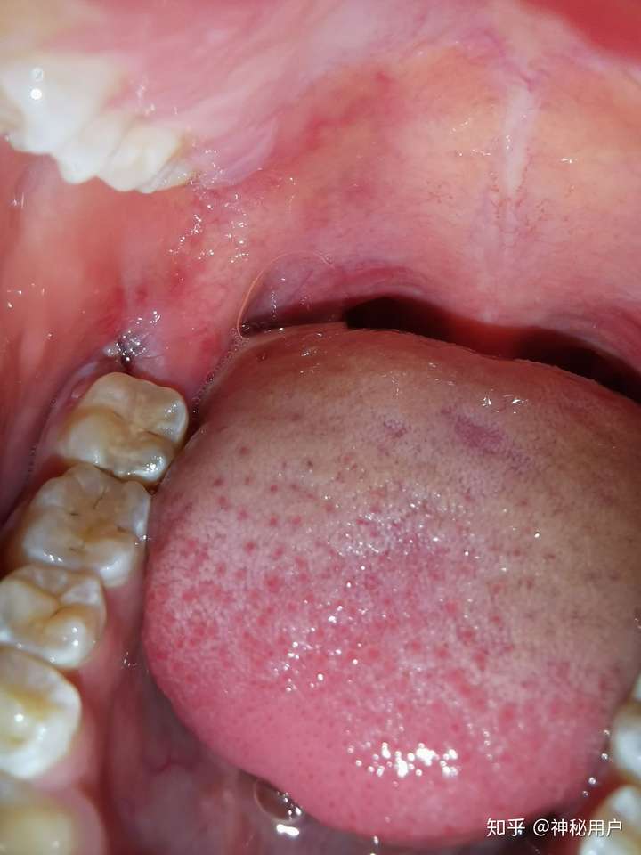 拔了智齿留的洞会长好吗?