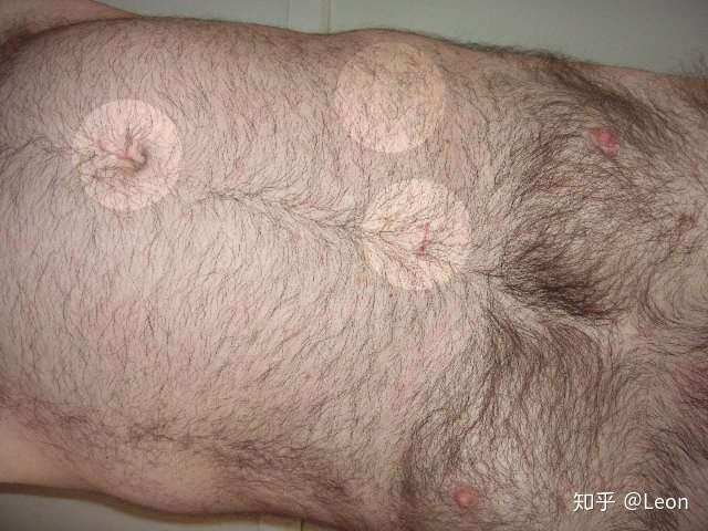 胆囊切除术cholecystectomy 知乎