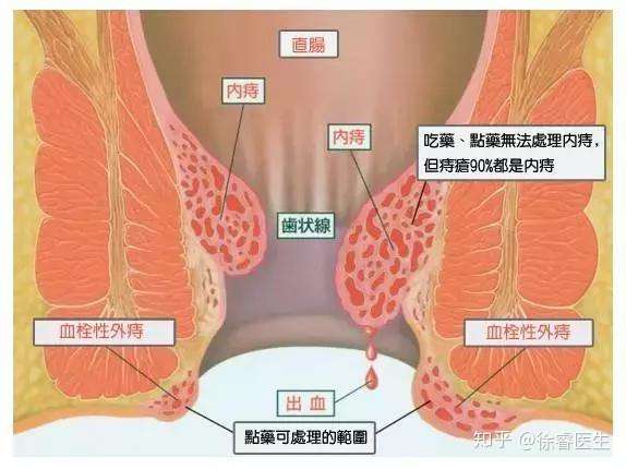 徐睿医生讲解 脱肛到底 脱 的是什么 知乎
