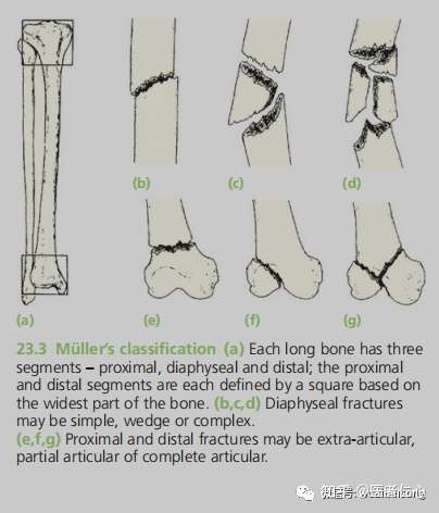 骨科英文书籍精读 2 骨折分型 知乎