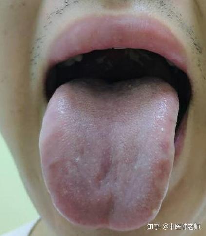 所以阳虚患者的舌苔都是淡舌