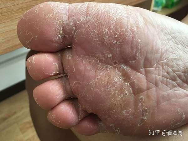 脚气大全 脚气是什么 怎么治 怎么判别 怎么不复发 知乎