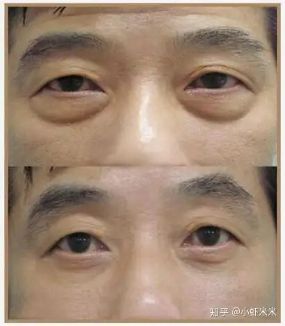 水剥离祛眼袋 - 知乎