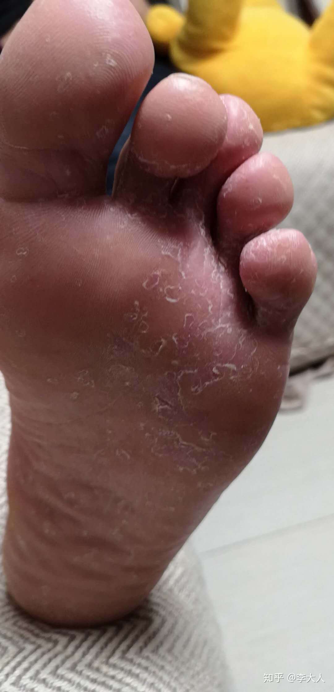 这样严重的脚气,应该怎样治疗呢?