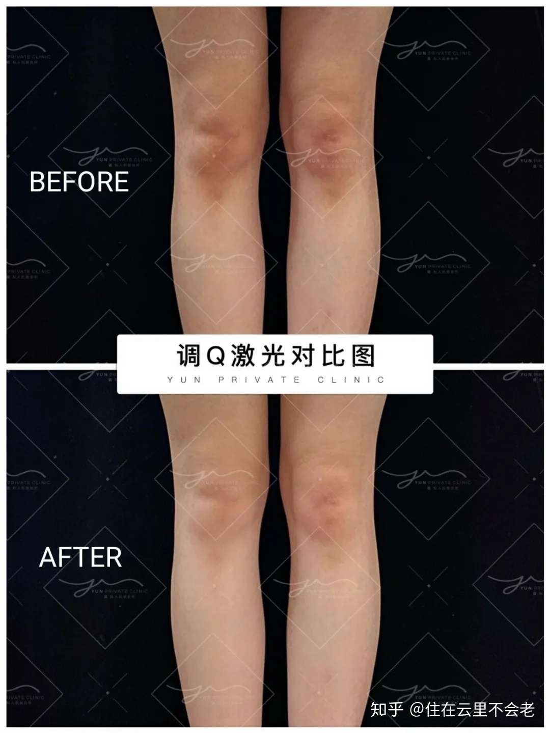 黑胳膊肘和黑膝盖 应该如何改呢 知乎