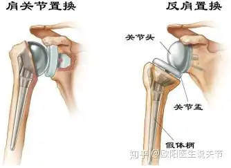 最后,专家提醒,如果患者出现肩袖巨大,不可修复的撕