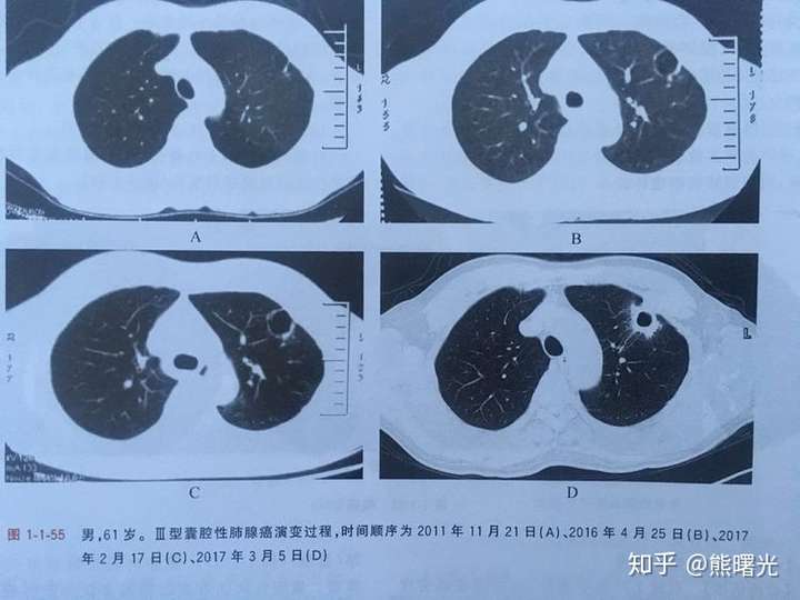 囊腔性肺癌 囊性空腔包括纤维化囊肿,空泡,肺大疱,伴或不伴肺气肿