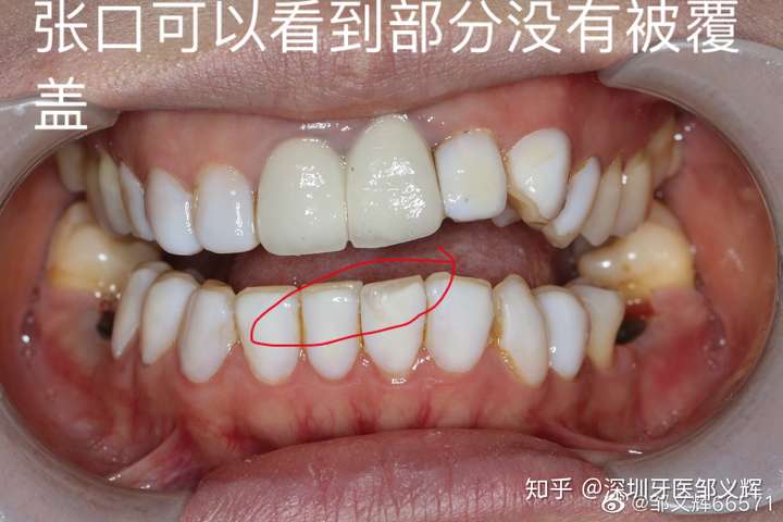 正面已經可以看到中間兩個是烤瓷牙,其他都是樹脂貼面,顏色已經發黃