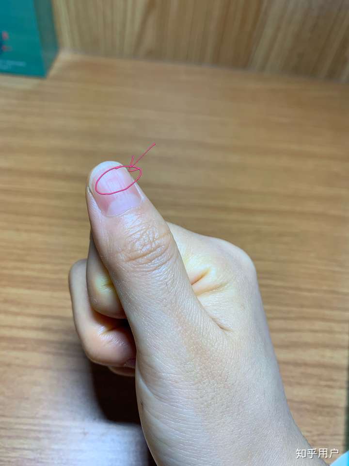 大拇指指甲凹凸不平有凸起的横纹和凹陷很多年了也没有其它问题去检查