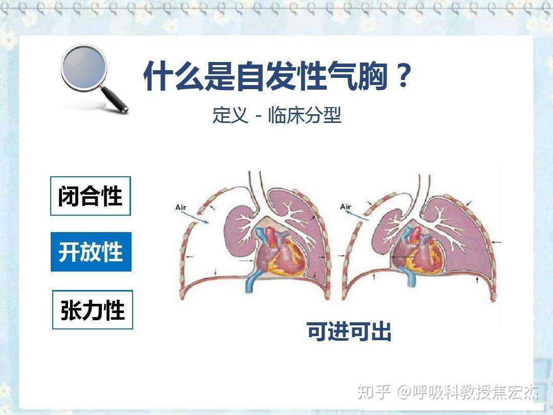 肺大泡到底应该怎么治 知乎