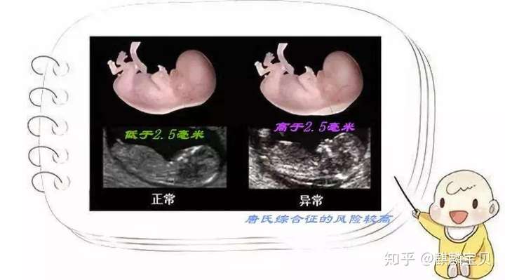 准妈妈不能错过的第一次排畸-NT插图(1) v2-30ad71985a2eed043fd9f3d276fd6762_720w.jpg插图(1)