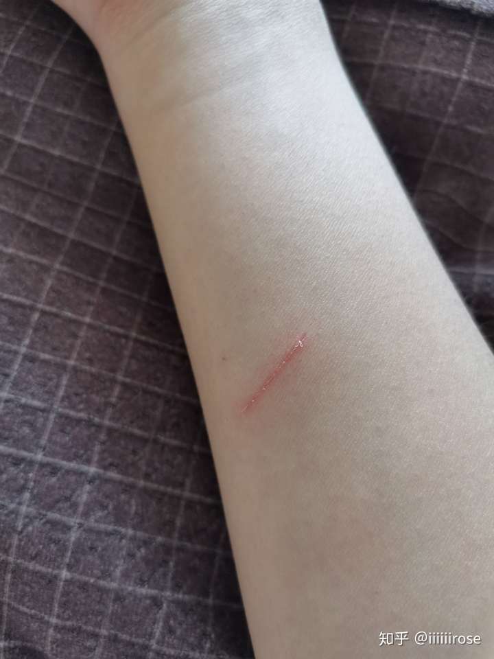 人打狂犬疫苗痛不痛?