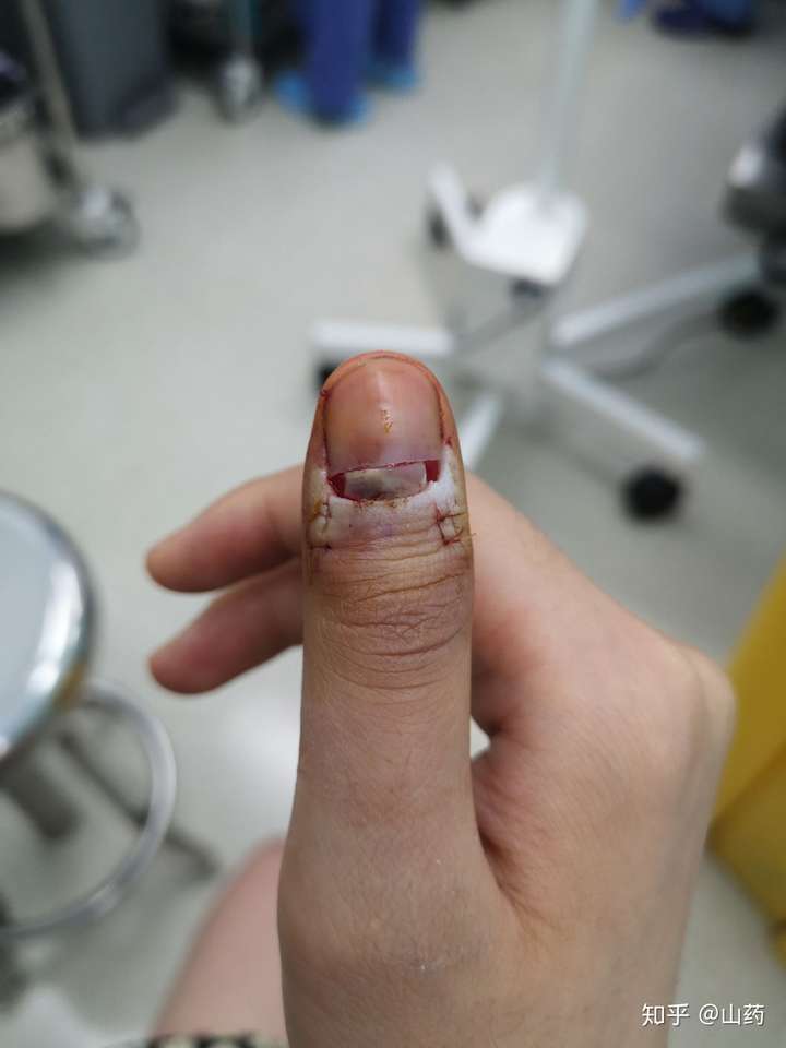 手指甲血管瘤图片图片