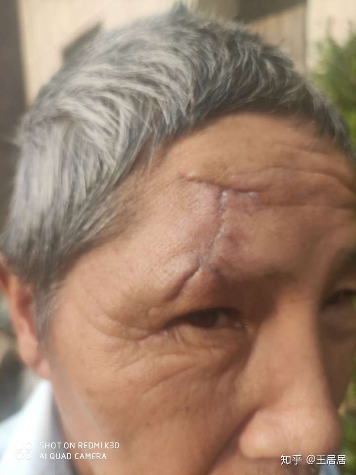 车祸脸部留疤索要45万赔偿可以吗