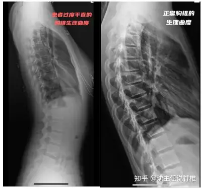 为了解释这个问题,我们来看看女孩的背部x光片.