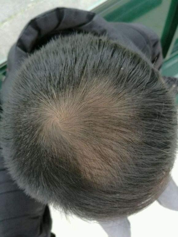 头发生发吃什么头发稀少吃什么有利于生发