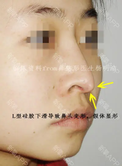 硅胶取出鼻子变化图片