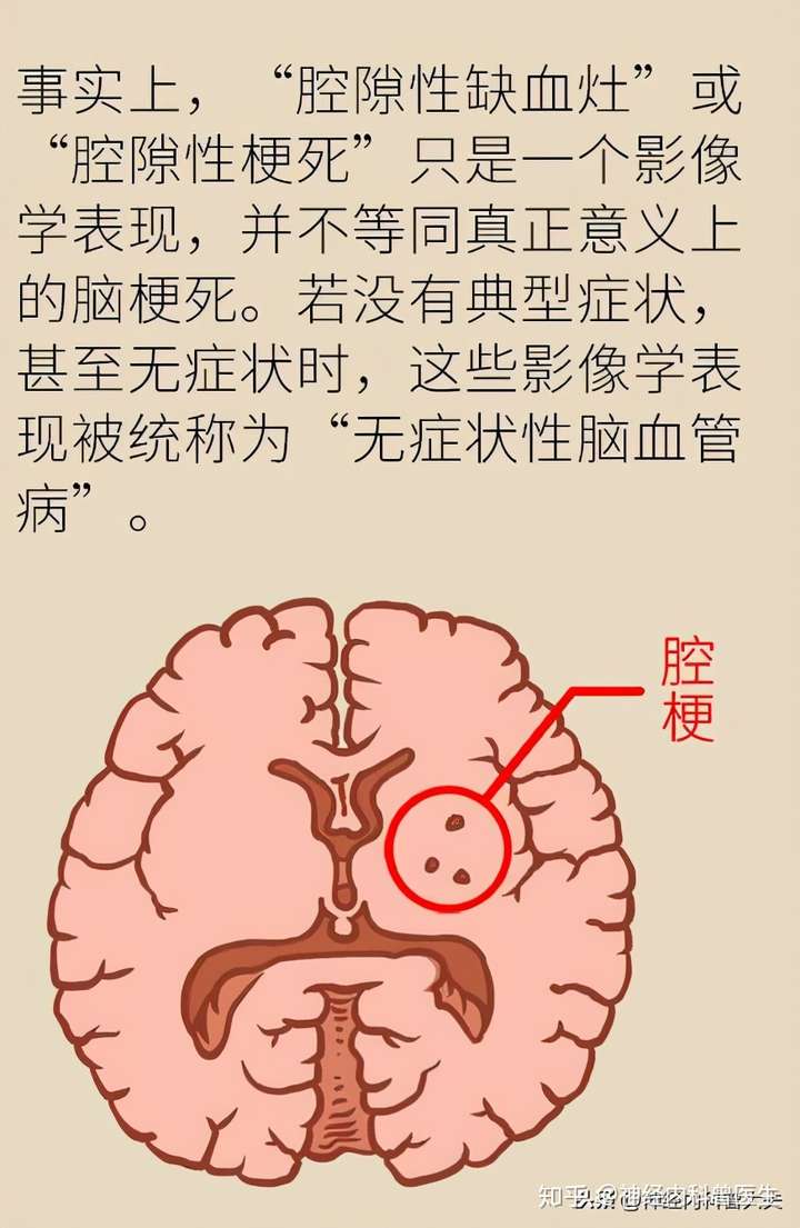 脑梗是什么病图片