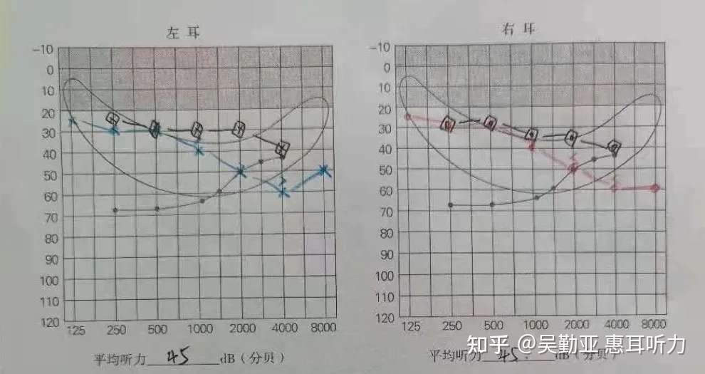 助听器体积大 听不清 有堵耳 这些问题的解决方法来啦 知乎