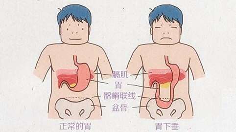 如果你知道胃下垂的危害还敢狼吞虎咽吗 知乎