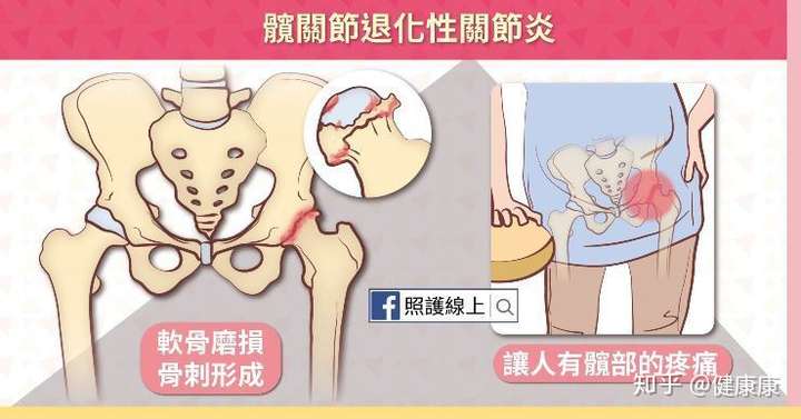 走路好痛9招緩和髖關節圖解