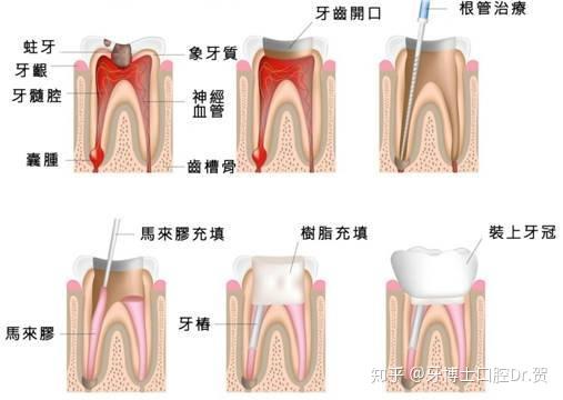 各乳牙的根管数目图图片