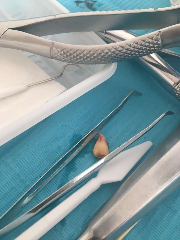 拔了右侧2颗四号牙,打麻药的瞬间还是后悔了的,好好地牙,就这样拔了