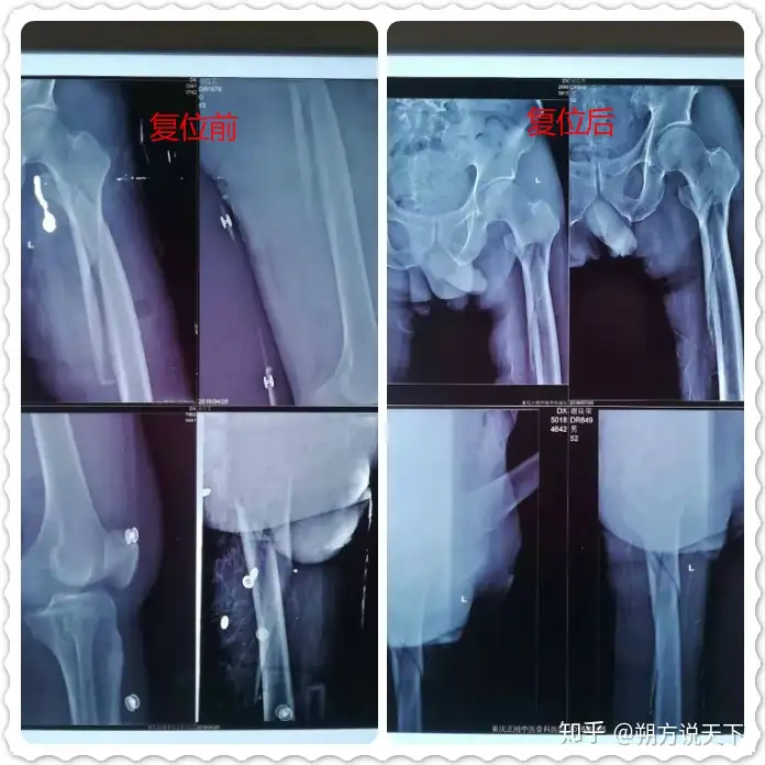 全国中医学术流派·千年传承非遗保护·重庆老字号-燕青门正骨派（重庆正刚中医骨科医院）（重庆十大中医名人） 第14张