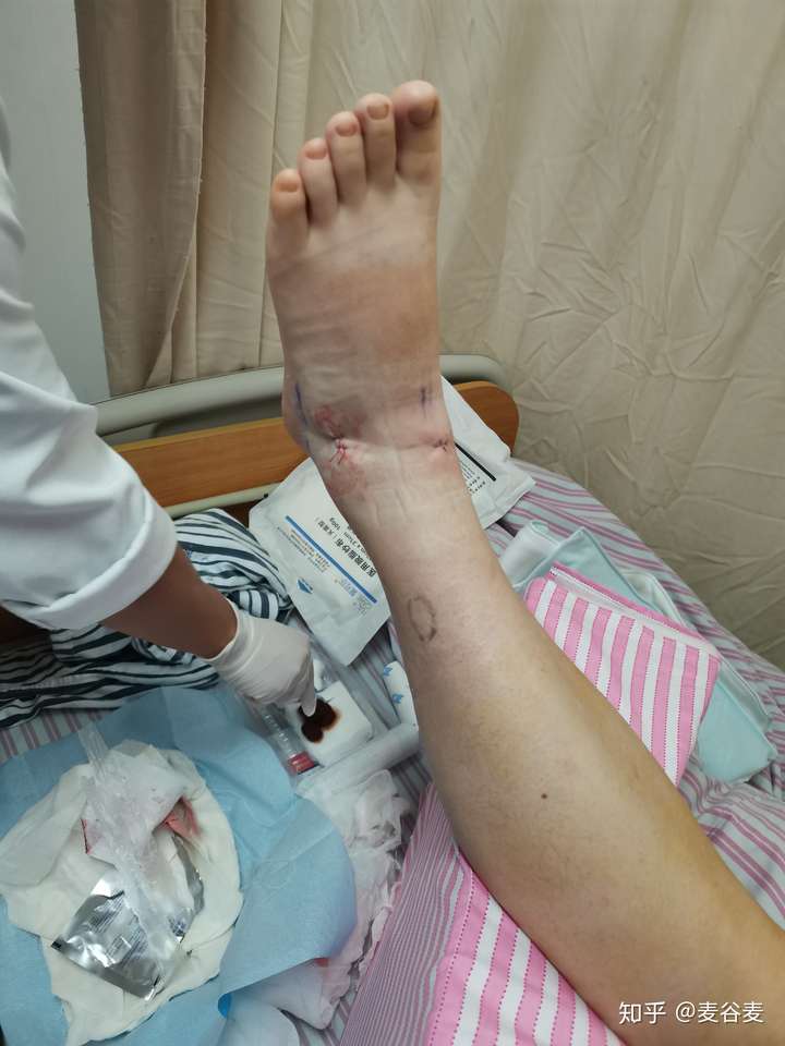 脚踝前距腓骨韧带修复手术康复历程