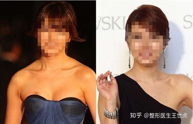 各路女明星都悄咪咪打的瘦肩针 你们千万别打 知乎