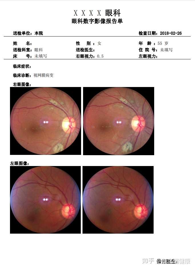 三面镜眼底检查图片图片