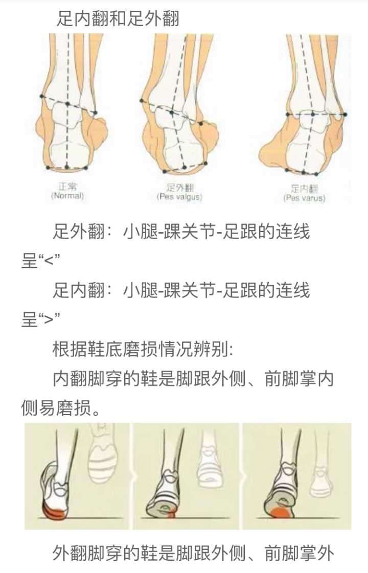 你根本就不知道你是扁平足 知乎