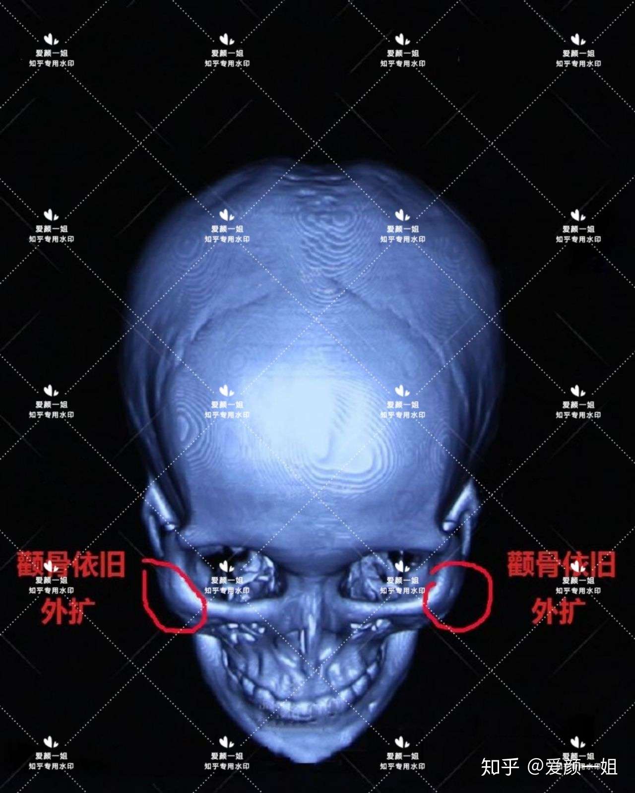 教你看ct 失败 这个准备做颧骨颧弓修复的 常问吉玟锡 杨君毅 郑康在 河东镐 王珍祥 刘祥夏 沈绍勇 知乎