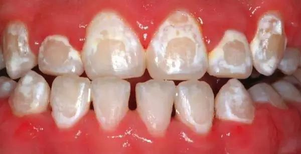 矫正期间牙齿出现白斑、白点是怎么回事？又该怎么办？