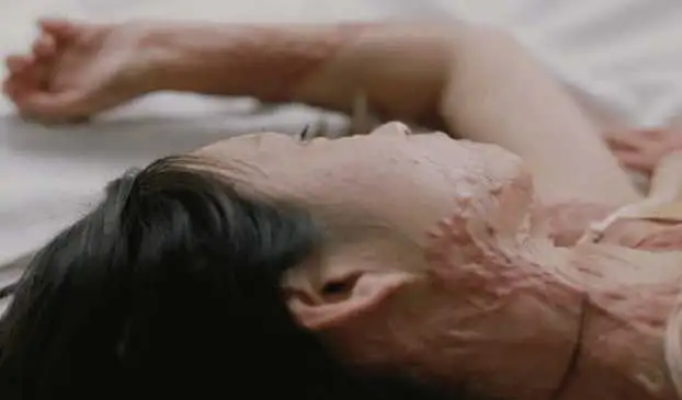 16岁女孩拒绝富二代求爱被泼硫酸现在她大方展示伤疤让人敬佩